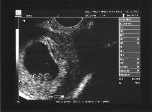 Our Baby, First Scan at 7 weeks 5 days