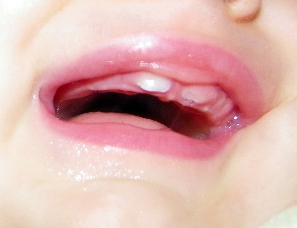 Addison's Top Teeth
